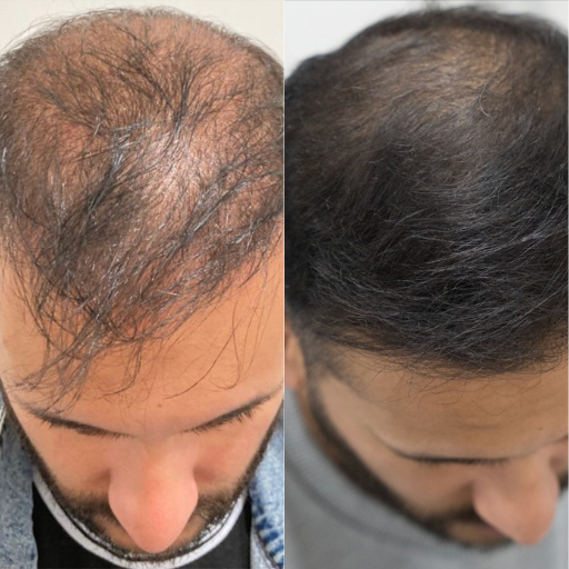 Hair'n Beard Stiméa™