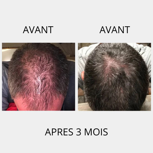 Hair'n Beard Stiméa™